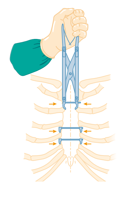 Sternal Closure Device (Sternum Clip)